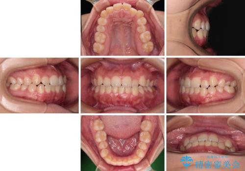前歯のクロスバイトを改善　インビザライン・モデレートによる矯正治療の治療前
