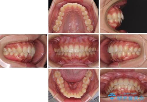 くちばしのような前歯 抜歯矯正で口を閉じやすくの治療前