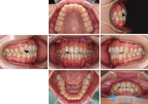 【モニター】オープンバイトをインビザライン矯正で治すの治療前
