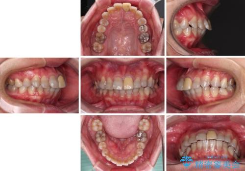 突出した前歯を引っ込める ワイヤー装置での抜歯矯正の治療前