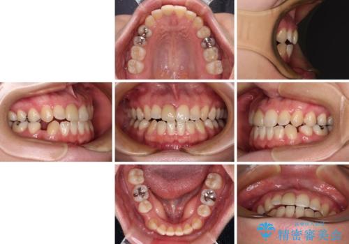 【モニター】後戻りでできた隙間 ワイヤー装置での再矯正の治療前