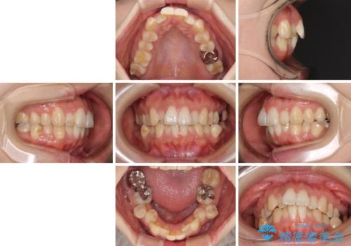 目立たない裏側装置でデコボコをきれいに解消の治療前