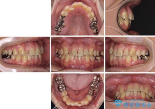 激痛の奥歯のむし歯治療 折角なので矯正治療もしたいの治療前