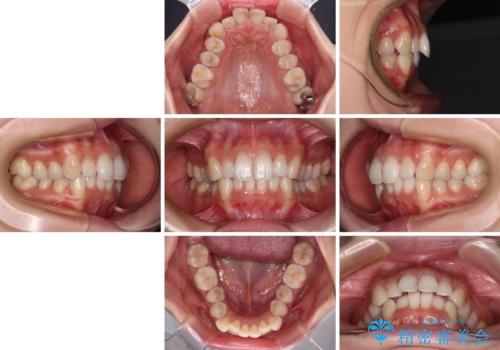 補助装置を用いて奥歯の咬み合わせを事前に改善 インビザラインによる矯正治療の治療前