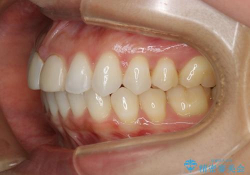 すきっ歯を治したい。インビザライン・ライトによる矯正治療の治療後