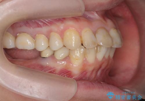 インプラント・セラミック・矯正治療を含む包括歯科診療の治療中