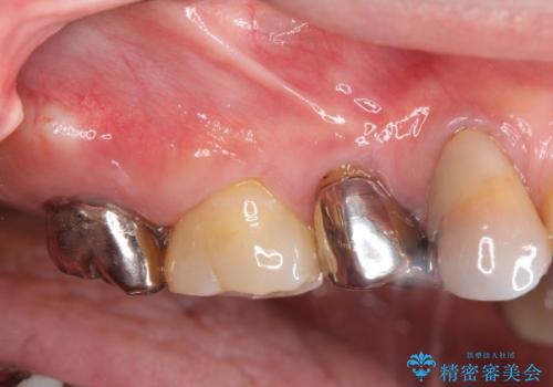 [ 歯槽堤保存術 ] [ 奥歯の破折 ]  ソケットプリザベーションを併用したインプラント治療の治療前