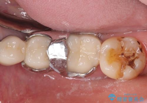 【セラミックインレー】詰め物が外れたので綺麗にしたいの治療前