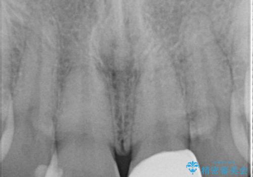 前歯が欠けた セラミッククラウンの治療後