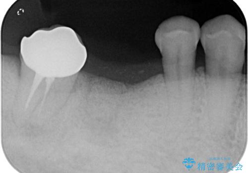 【インプラント】奥歯でしっかり物を噛みたい。の治療前