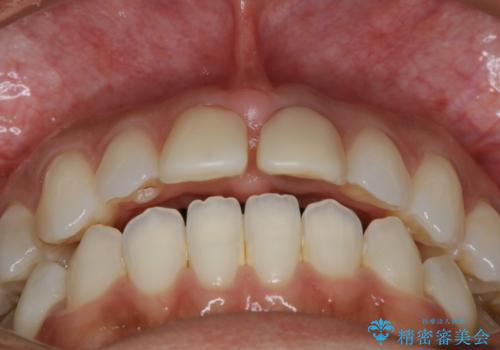 すきっ歯を治したい。インビザライン・ライトによる矯正治療の治療前