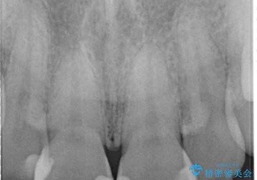 前歯が欠けた セラミッククラウンの治療中