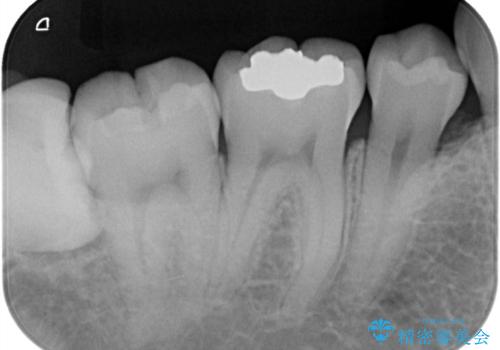 【セラミックインレー】銀歯を外したいの治療前