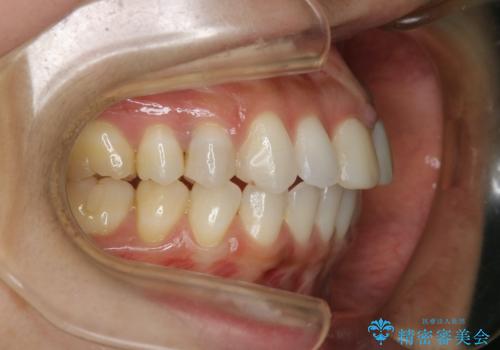 すきっ歯を治したい。インビザライン・ライトによる矯正治療の治療後