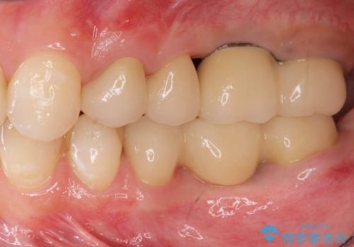 インプラント・セラミック・矯正治療を含む包括歯科診療の治療後