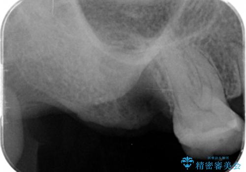[ 歯槽堤保存術 ] [ 奥歯の破折 ]  ソケットプリザベーションを併用したインプラント治療の治療前