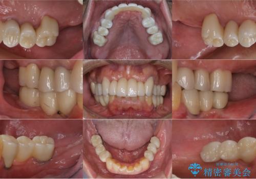 孫から口臭を指摘され来院、全顎治療で噛み合わせ、見た目、口臭全て劇的改善!の治療後