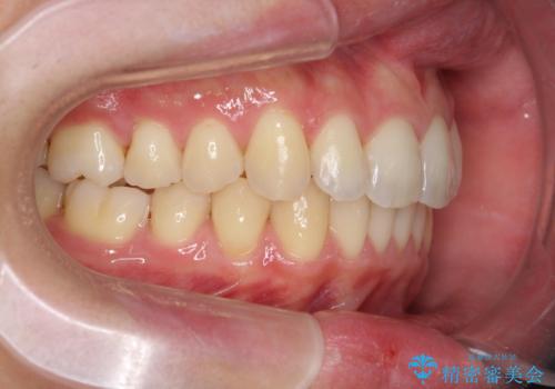 過蓋咬合・上顎前突・叢生を改善するマウスピース矯正