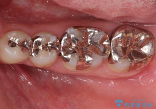 APF(歯肉弁根尖側移動術)の治療前