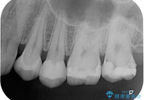 e-maxインレー治療の治療後