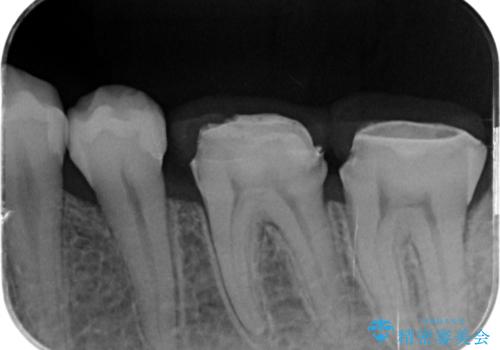 APF(歯肉弁根尖側移動術)の治療後