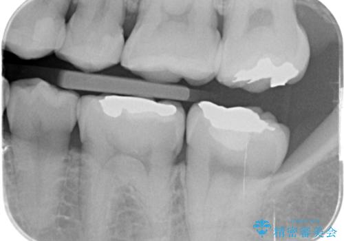 銀歯の横が虫歯、自費治療でやり直してセラミックにの治療前