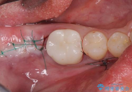 歯がないところにインプラントを入れたいの治療中