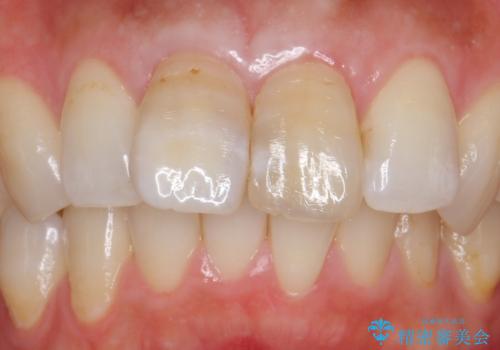 変色した歯を綺麗にしたい　根管治療からジルコニアクラウンでの修復の症例 治療前