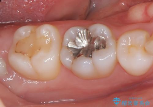 【セラミックインレー】銀歯を外したいの治療前