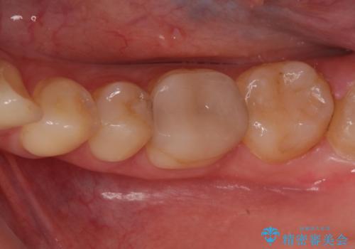 精度の低い詰め物のやり替えの症例 治療前
