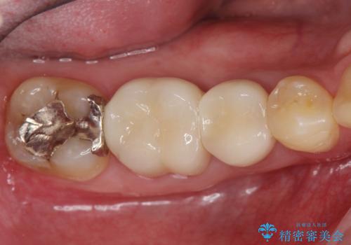 深い虫歯　セラミッククラウンの精度を高める歯周外科手術の治療後