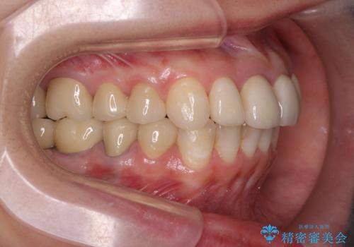 インプラント・セラミック・矯正治療を含む包括歯科診療の治療後