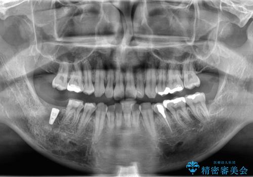銀歯を白くしたい。(インプラント治療)の治療後