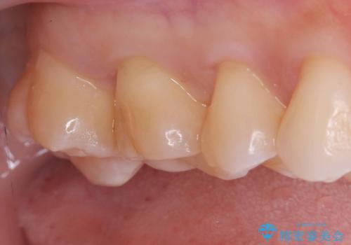 【セラミックインレー】咬合面のカリエスの治療後