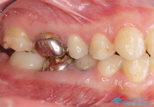 インプラント・セラミック・矯正治療を含む包括歯科診療の治療前