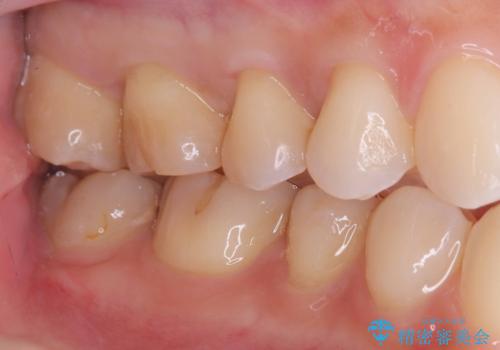 【セラミックインレー】咬合面のカリエスの治療後