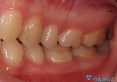 精度の低い詰め物のやり替えの治療前