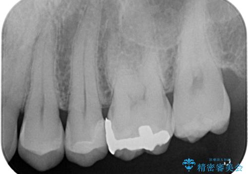 【セラミックインレー】他院で詰めた銀歯がフロスをしたら取れた!の治療後