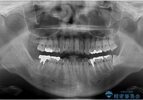 銀歯を白くしたい。(インプラント治療)の治療前