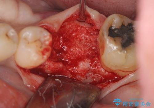 失った奥歯をインプラントで機能回復の治療中