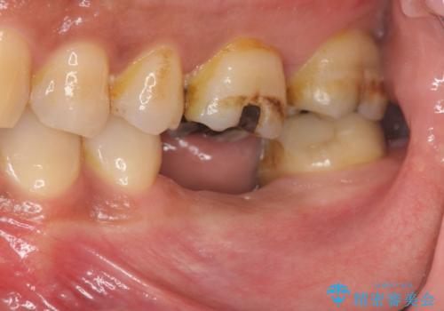 失った奥歯をインプラントで機能回復の治療前