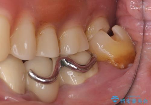 【セラミックインレー】詰め物が外れたので綺麗にしたいの治療中