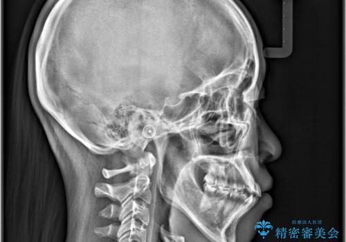【抜歯矯正】クリア装置で1年半の治療前