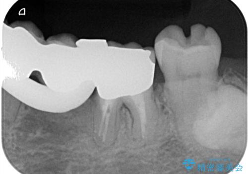 【セラミックインレー】詰め物が外れたので綺麗にしたいの治療前