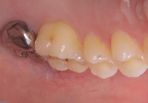 【セラミッククラウン】歯並びも綺麗になったし歯も白くしたいの治療前