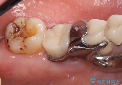 【セラミックインレー】詰め物が外れたので綺麗にしたいの治療前