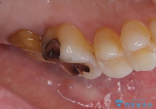 詰め物と歯の境目に汚れが溜まるの治療前
