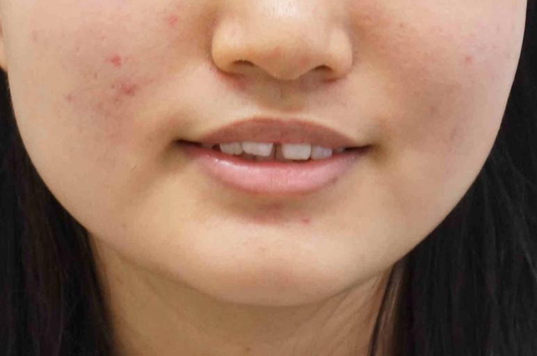 前歯のすき間が気になる 部分矯正での治療前(顔貌)