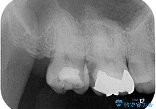 歯周外科処置を併用した奥歯のむし歯治療の治療前