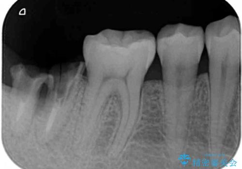 部分矯正で咬み合わせを改善　奥歯のインプラント治療の治療前